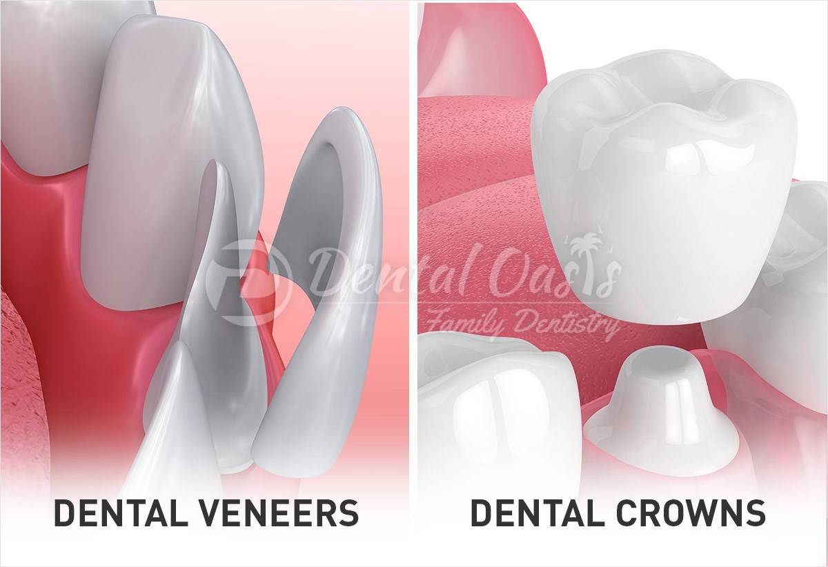 dental-veneers-vs-crowns