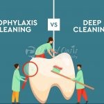 Prophylaxis Cleaning vs Deep cleaning