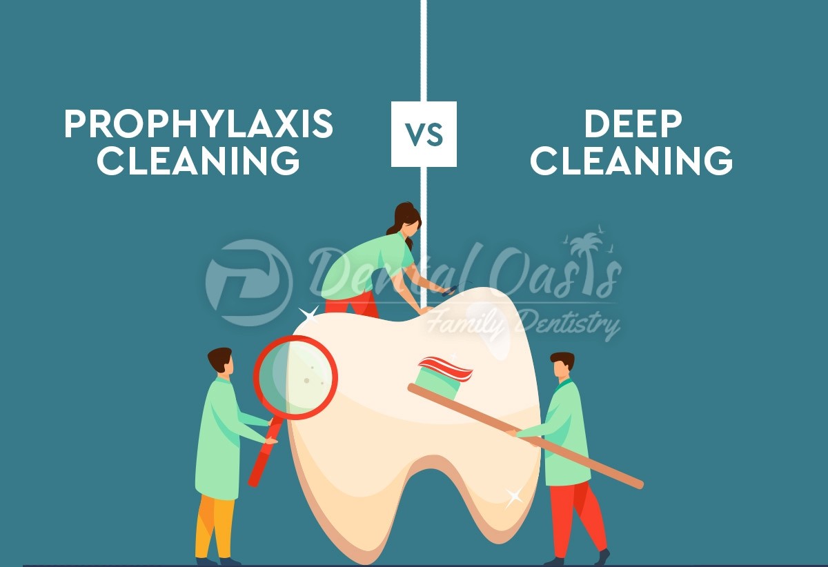 Prophylaxis Cleaning vs Deep cleaning