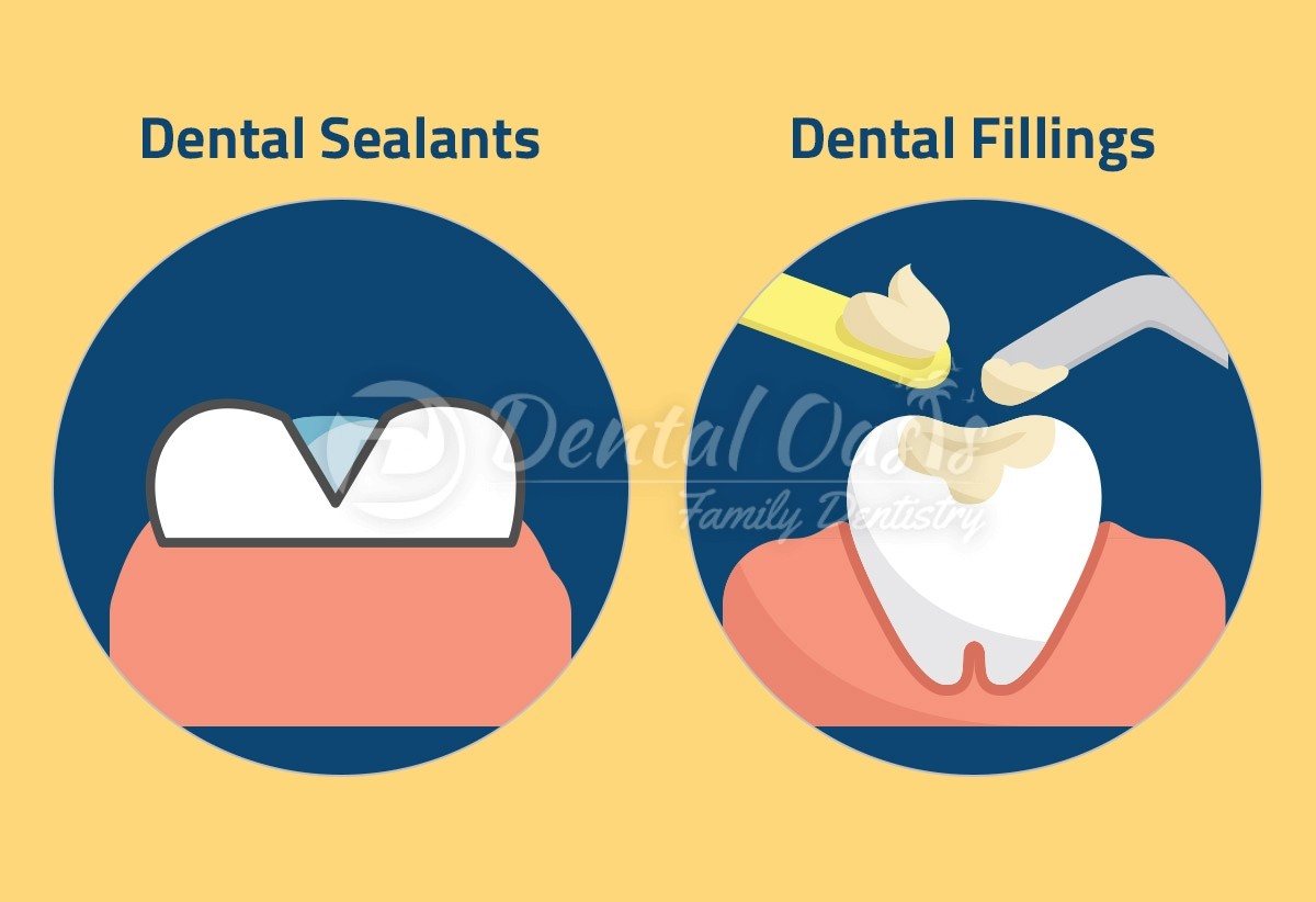 Sealants vs fillings