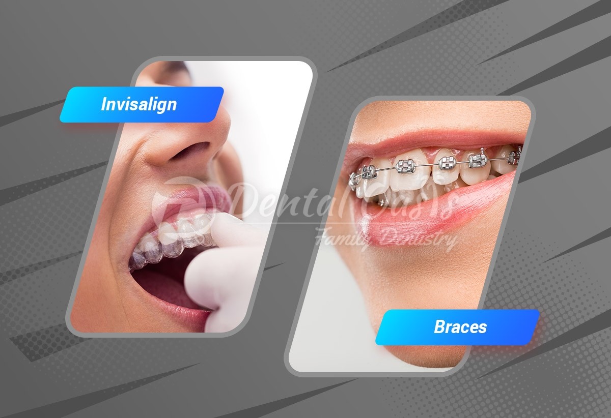 Invisalign and braces