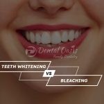 Teeth Whitening, Teeth Bleaching