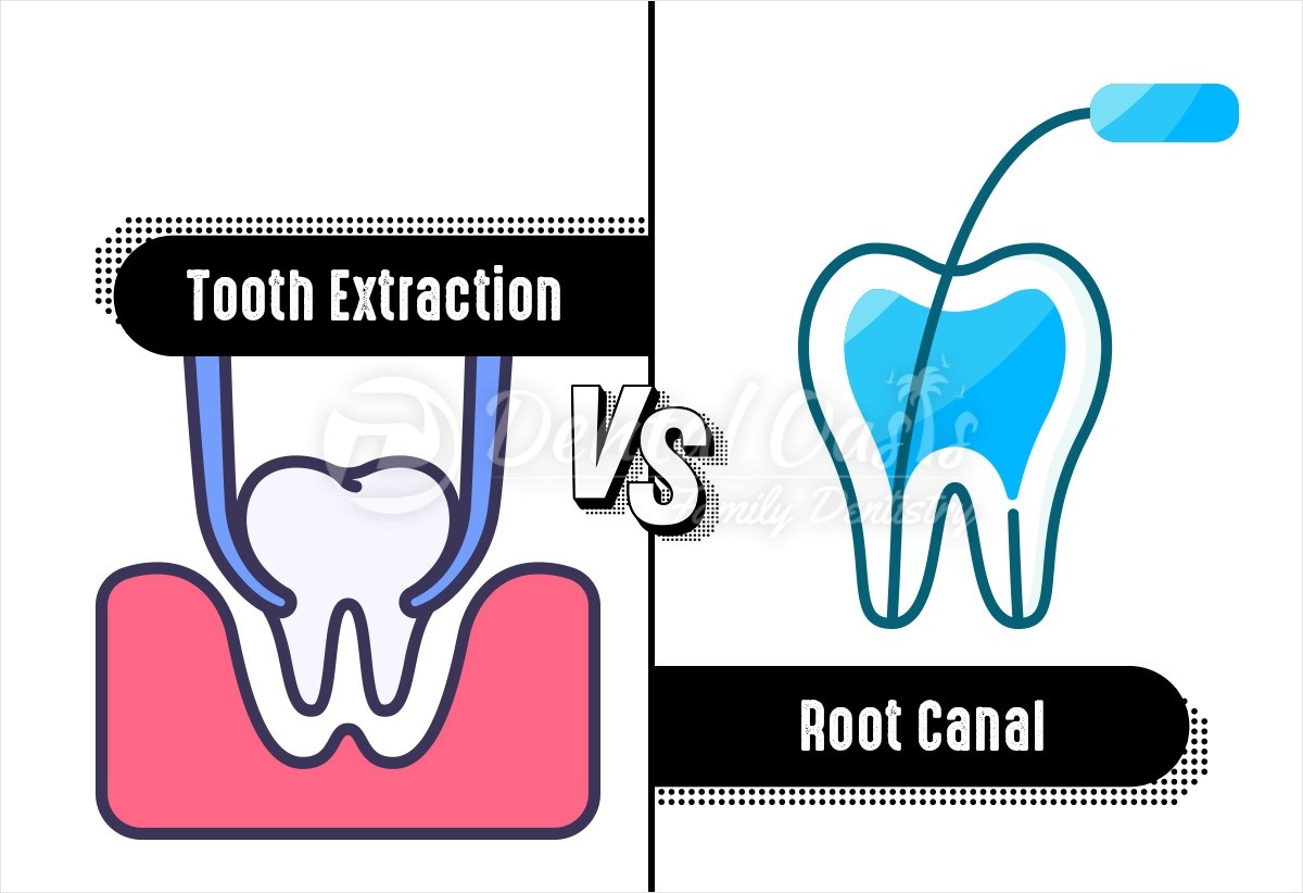 tooth extraction vs root canal
