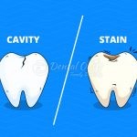 cavity vs stain