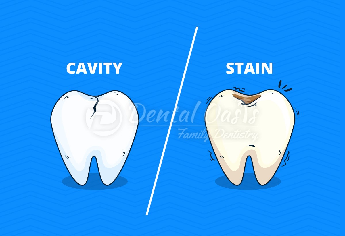 cavity vs stain