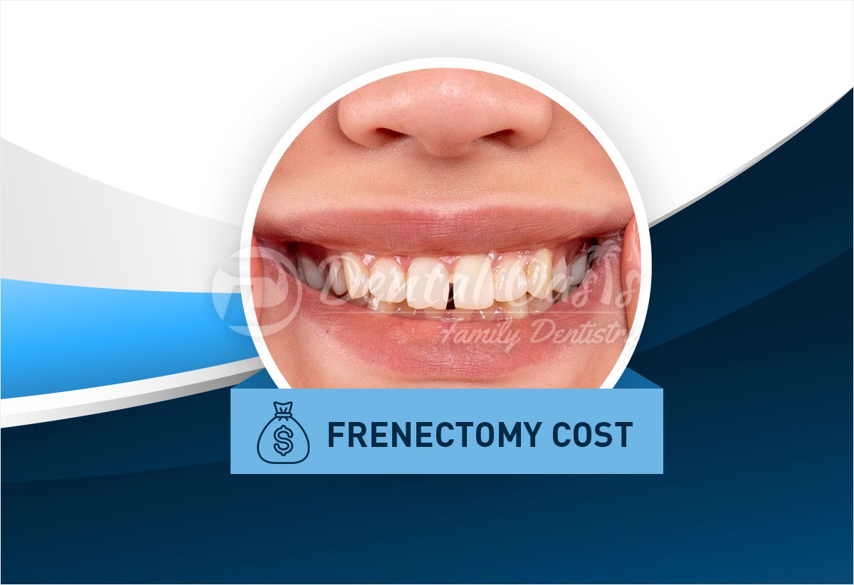 frenectomy cost